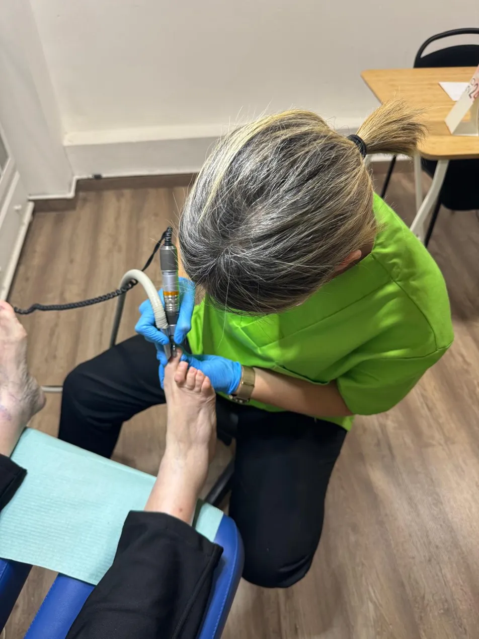Quiropodia profesional en Terrassa — eliminación de callos y durezas
