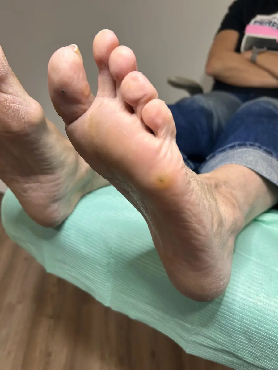Quiropodia profesional en Terrassa — eliminación de callos y durezas